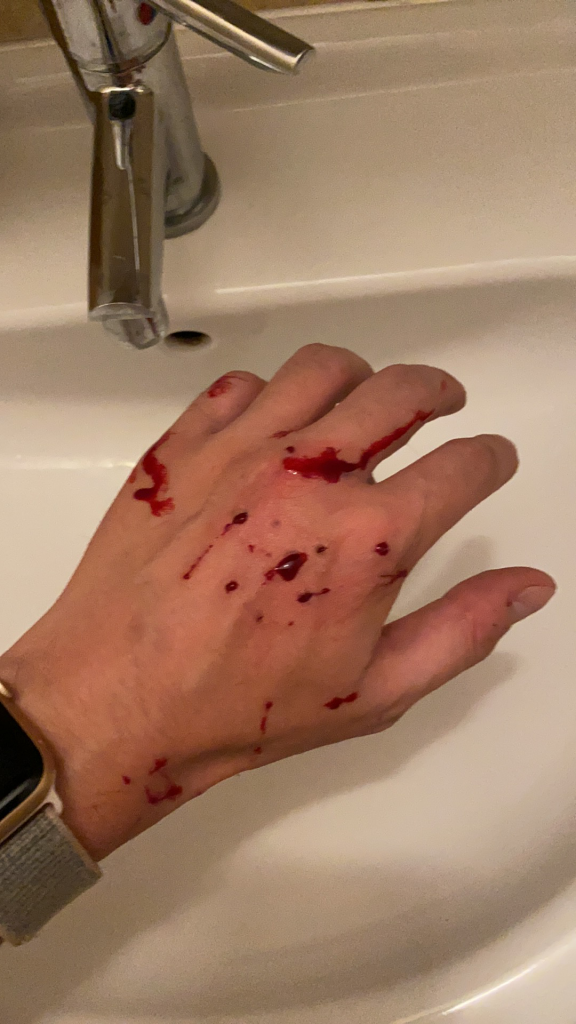 Blood from cat scratches